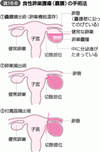 良性卵巣腫瘍の手術法